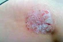 Psoriasis